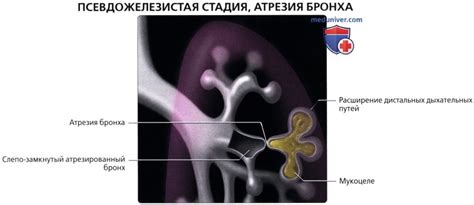 Методы лечения бронхоцеле