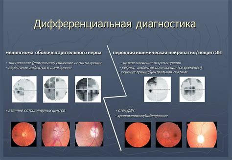 Методы лечения субкортикальной атрофии