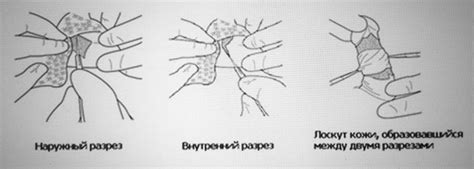 Методы проведения обрезания