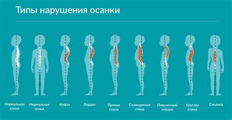 Нарушения осанки и положения тела