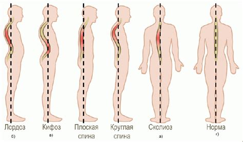 Нарушения осанки и сухость кожи