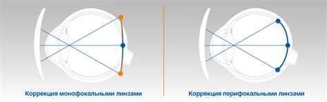 Недостатки перифокальных очков: