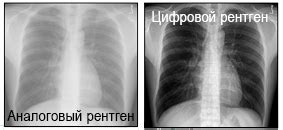 Недостатки цифрового рентгена