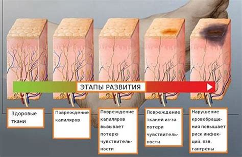 Нейропатия и ожоги