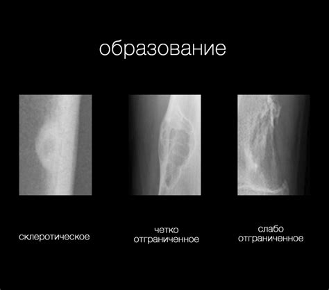 Некроз при определении опухолей