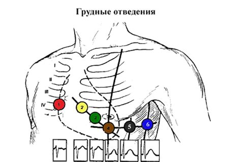 Ограничения при проведении ЭКГ