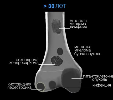 Опасность использования только костей