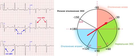 Определение качества ЭКГ