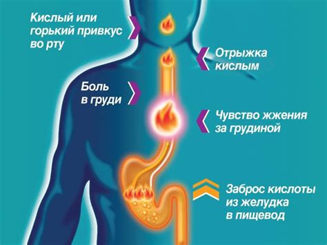 Основные признаки изжоги