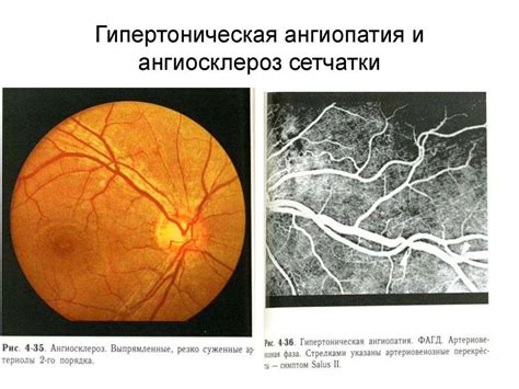 Основные симптомы гиперплазии сетчатки