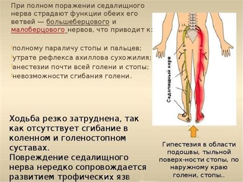 Основные симптомы ущемления седалищного нерва