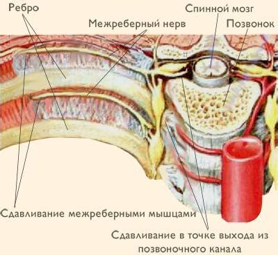 Остеохондроз: вероятная причина онемения