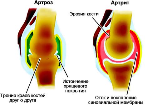 Остеохондроз и артрит