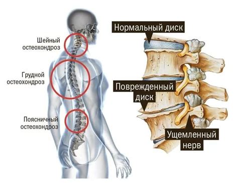 Остеохондроз и его последствия