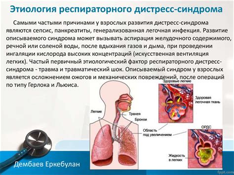 Острый респираторный дистресс-синдром: осложнение с дыхательной недостаточностью