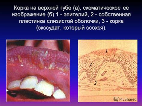 Патологические процессы в полости рта, приводящие к нарушению испарения