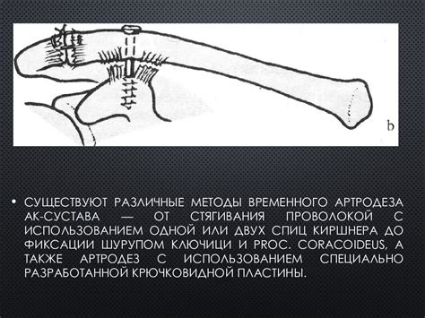 Повреждения сочленения