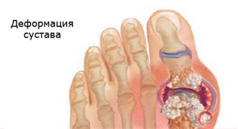 Подагра и питание: важные аспекты