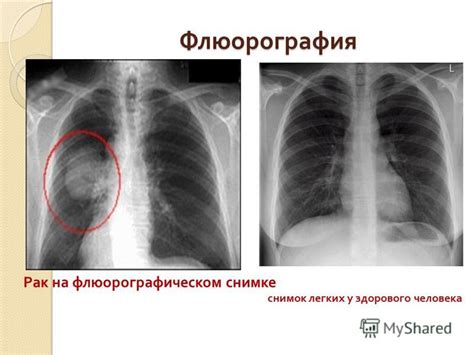 Порядок действий перед проведением флюорографии при подозрении на воспаление легких