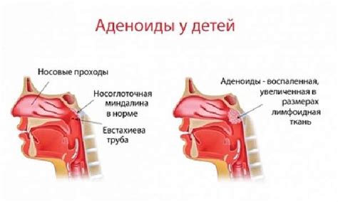 Последствия удаления аденоидов