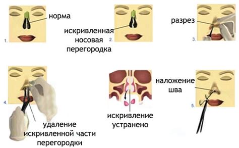 Почему искривляется носовая перегородка