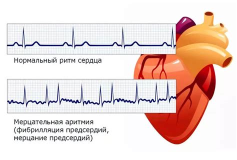 Почему предсердный ритм переходит