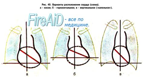 Правостороннее положение сердца