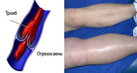 Предотвращение отека и тромбоза