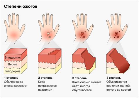 Прививка при ожогах