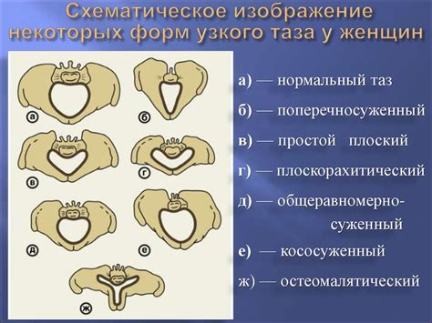 Признаки узкого таза у девушки