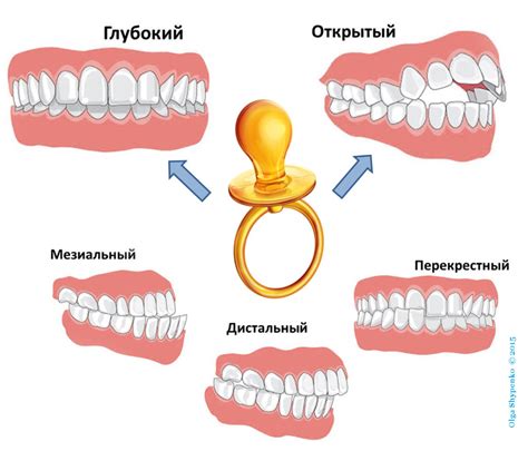 Прикус: основные причины