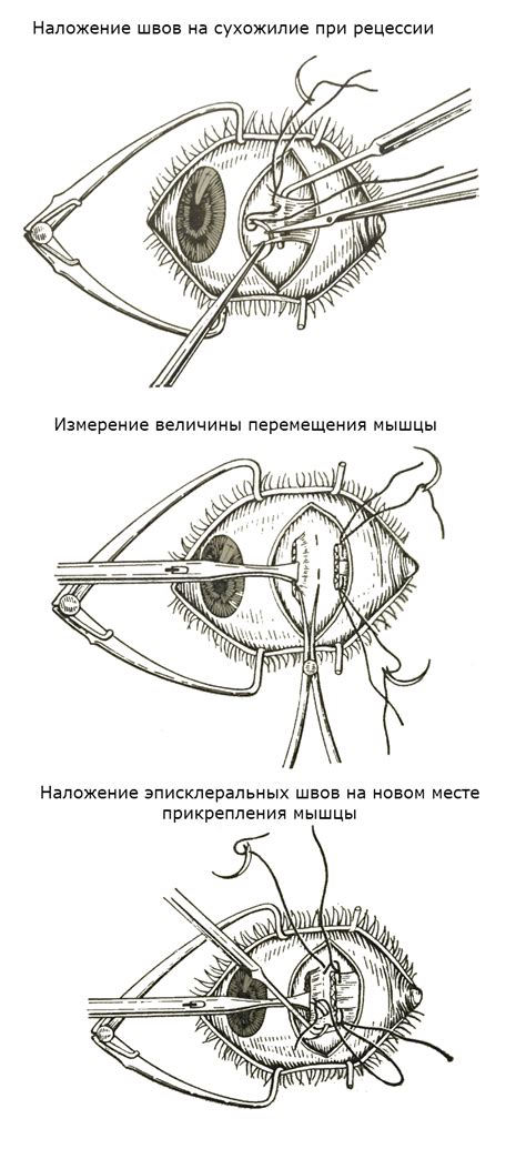 Принципы визометрии глаза