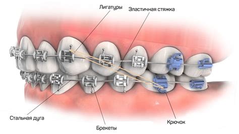 Приобретение комплекта брекетов