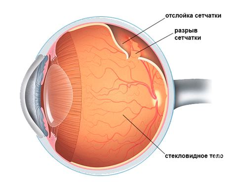 Причины васкулогенеза недоразвитой сетчатки