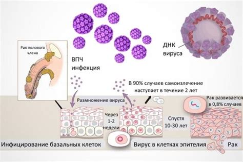 Причины возникновения ВПЧ 52