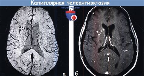 Причины возникновения и развития капиллярной телеангиэктазии головного мозга