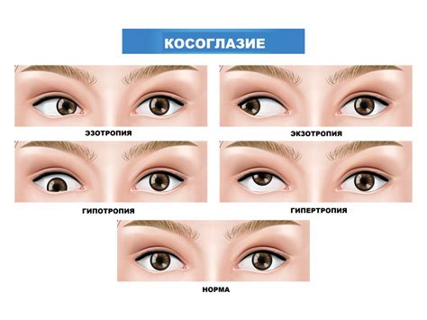 Причины возникновения косоглазия