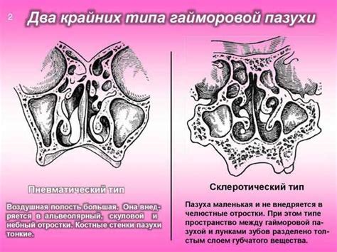 Причины возникновения пневматизации пазух