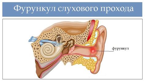 Причины гнойника в ухе