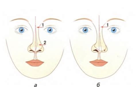 Причины кривого носа в одну сторону