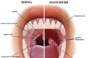 Причины образования белых отложений в горле