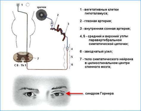 Причины синдрома Горнера