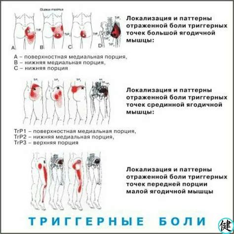 Профилактические меры для предотвращения болей в ягодицах