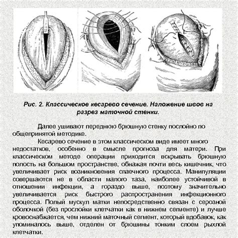 Процедура кесарева сечения