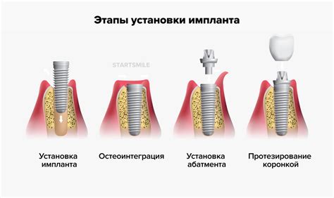 Процесс установки и правильная фиксация