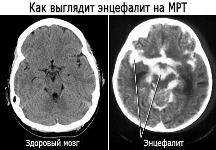 Проявления энцефалита у человека