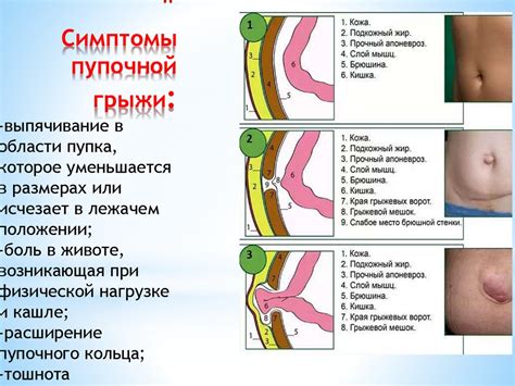 Пупочная грыжа: важность консультации специалиста