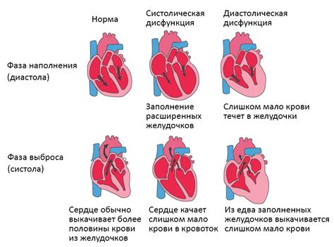 Сердечная недостаточность у взрослых