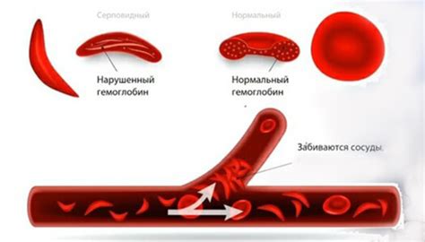 Серповидноклеточная анемия: