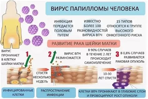 Симптомы ВПЧ 52 у женщин